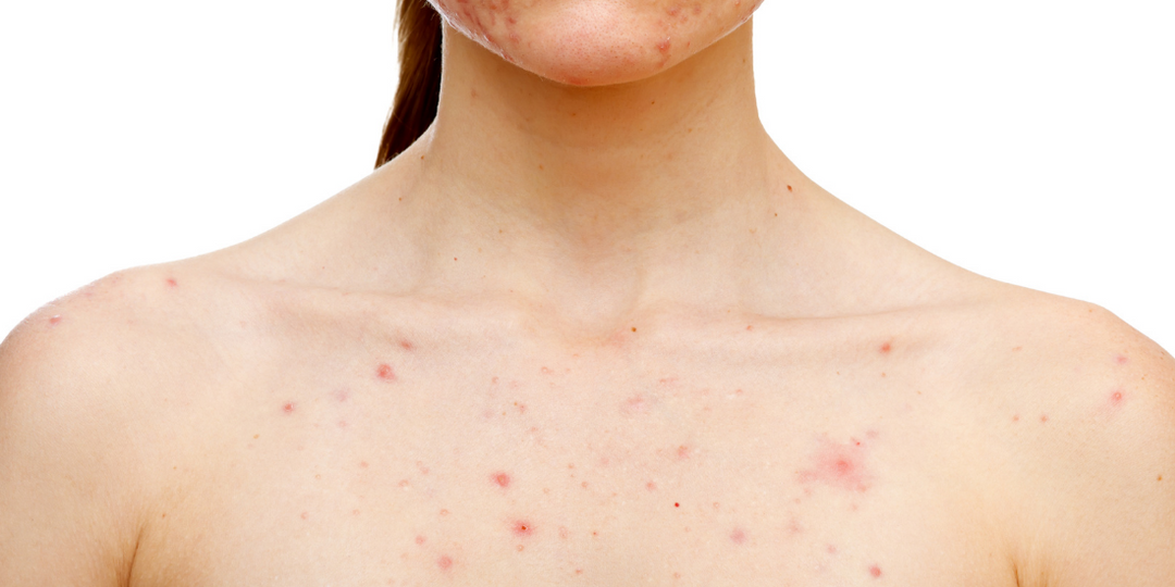 Acne op de borst Laserkliniek